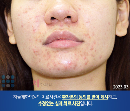 얼굴여드름