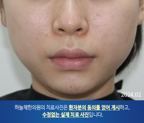 얼굴여드름