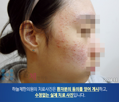 얼굴여드름