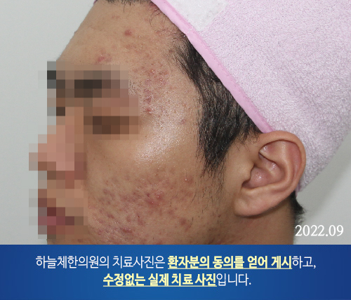 얼굴여드름