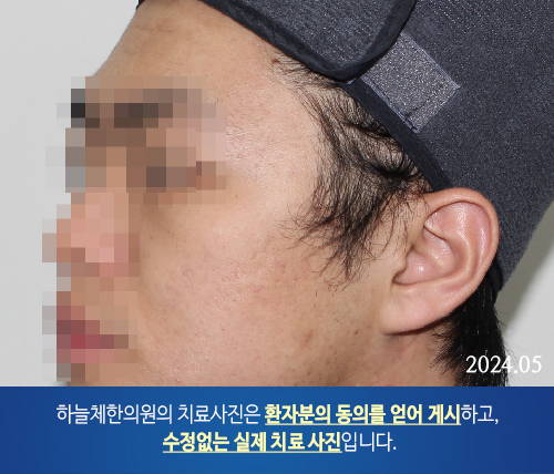 얼굴여드름