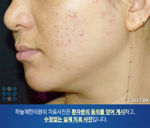 얼굴여드름