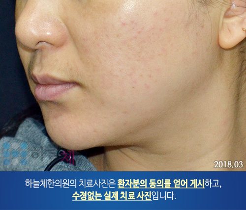 얼굴여드름