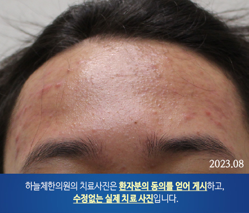 얼굴여드름