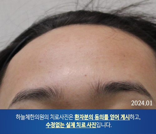 얼굴여드름