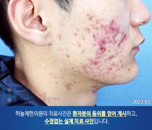여드름흉터/자국