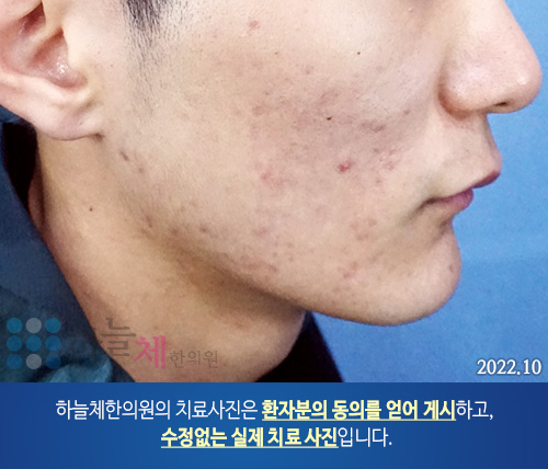 여드름흉터/자국