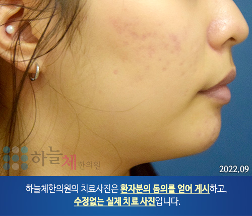 여드름흉터/자국