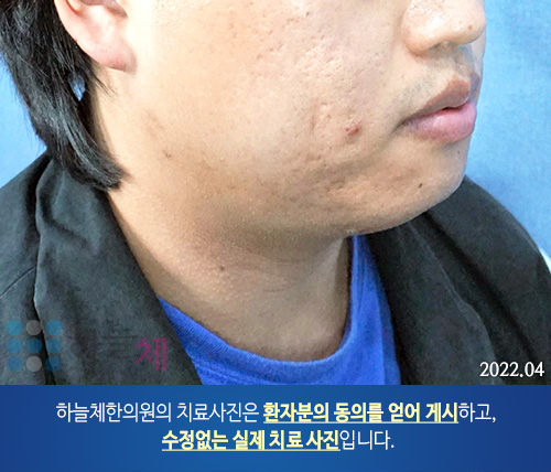 여드름흉터/자국