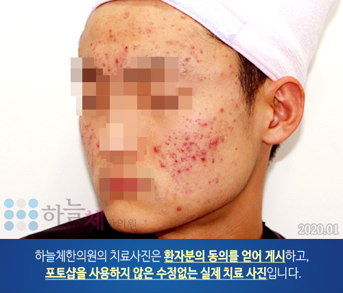 여드름흉터/자국