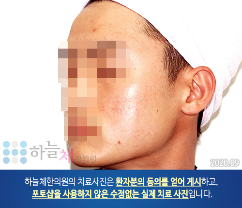 여드름흉터/자국