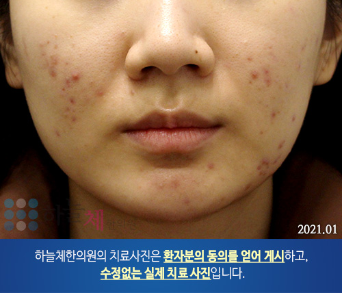 여드름흉터/자국