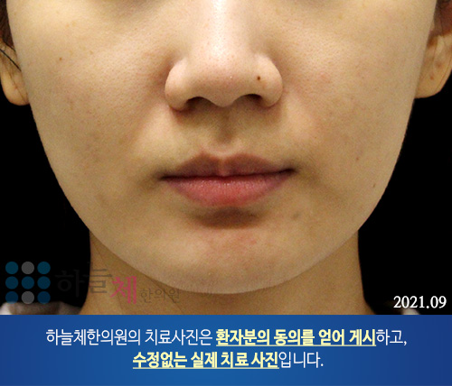 여드름흉터/자국