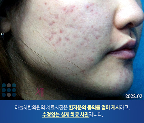 여드름흉터/자국