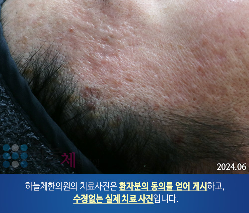 피부질환