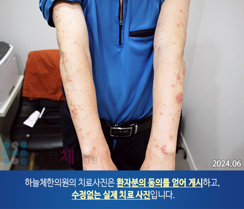 피부질환