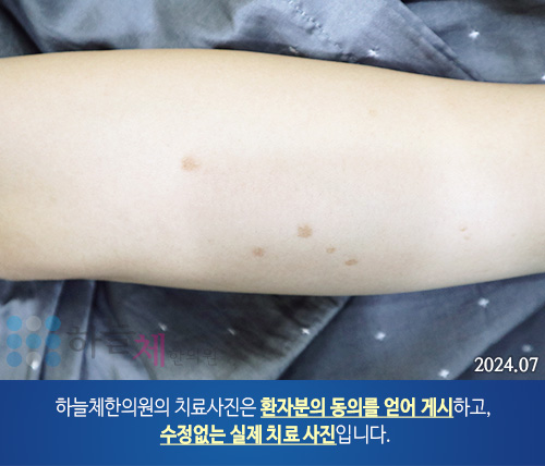 피부질환