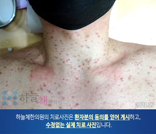 몸여드름