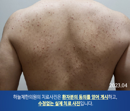 몸여드름
