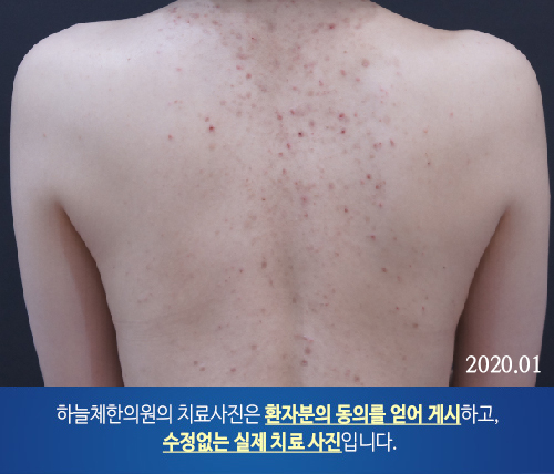 몸여드름