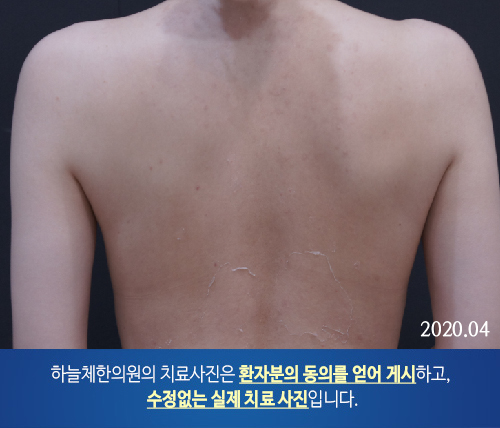몸여드름