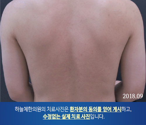 몸여드름