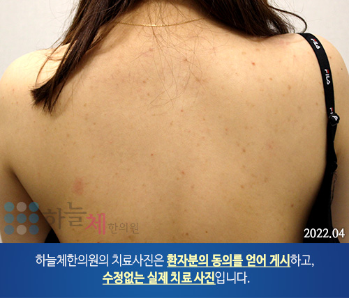 몸여드름