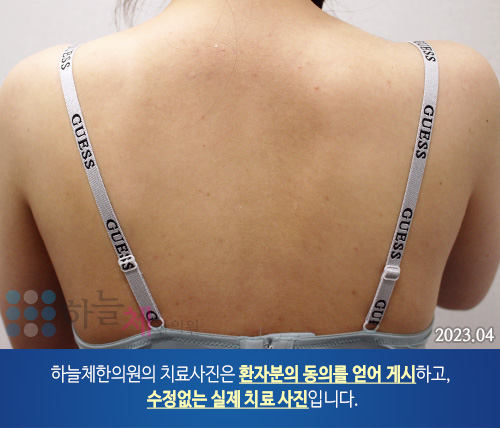 몸여드름